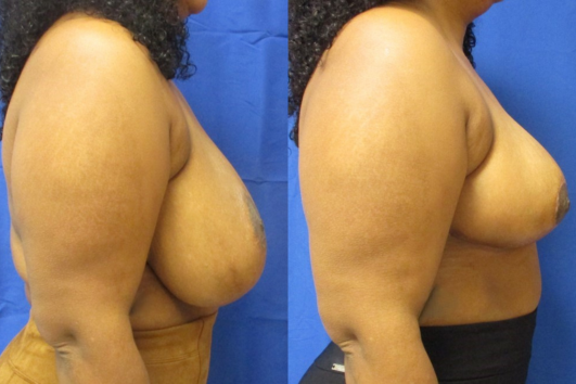 breast reduction before & after