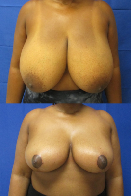 breast reduction before & after