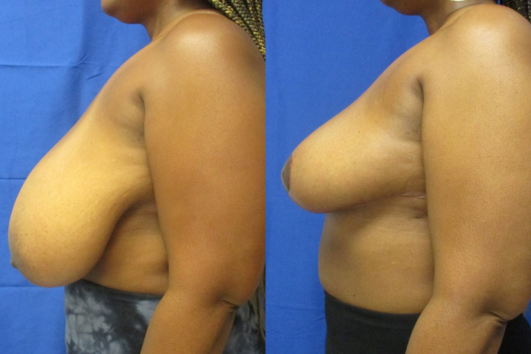 breast reduction before & after