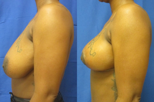 breast reduction before & after