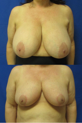 breast reduction before & after