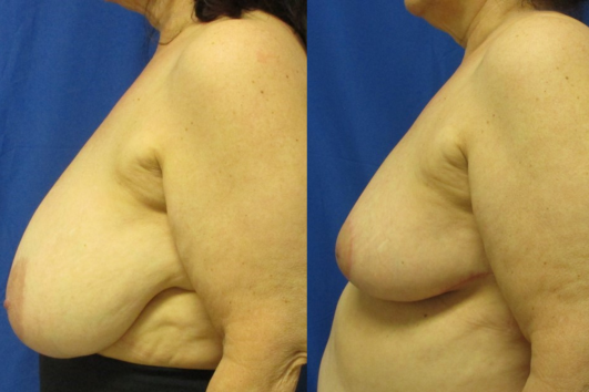 breast reduction before & after