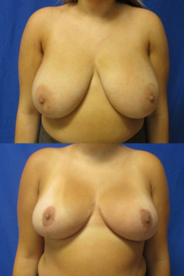 breast reduction before & after