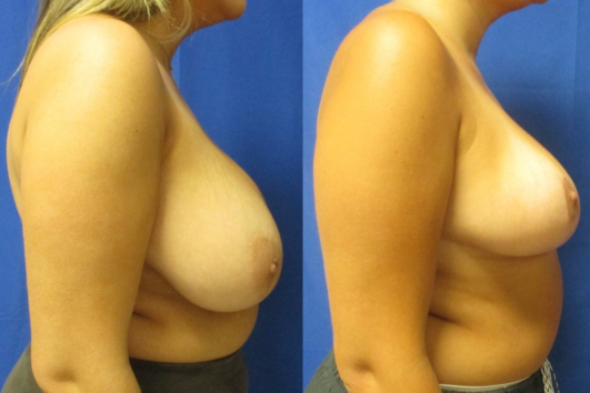 breast reduction before & after