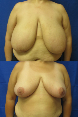 breast reduction before & after