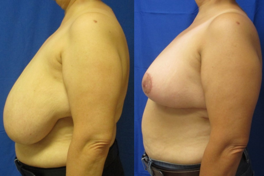 breast reduction before & after