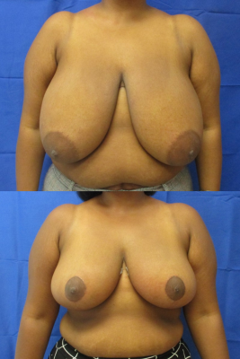 breast reduction before & after