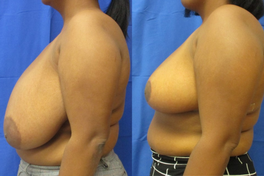 breast reduction before & after