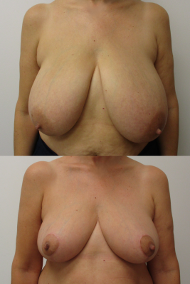 breast reduction before & after