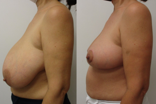 breast reduction before & after