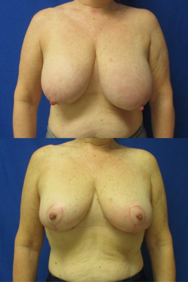 breast reduction before & after