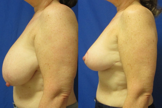 breast reduction before & after