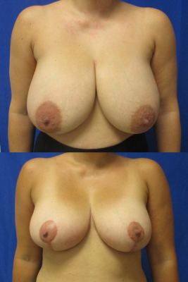 breast reduction before & after