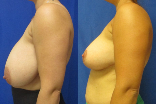 breast reduction before & after