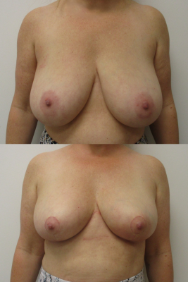 breast reduction before & after