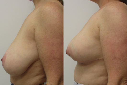 breast reduction before & after