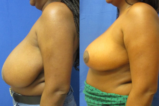 breast reduction before & after