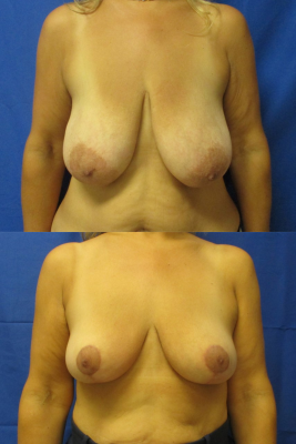 breast reduction before & after