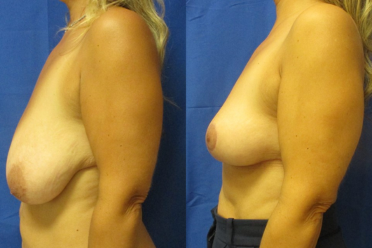 breast reduction before & after