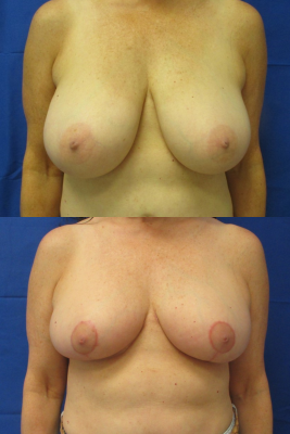 breast reduction before & after