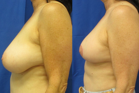 breast reduction before & after