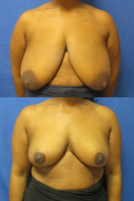 breast reduction before & after