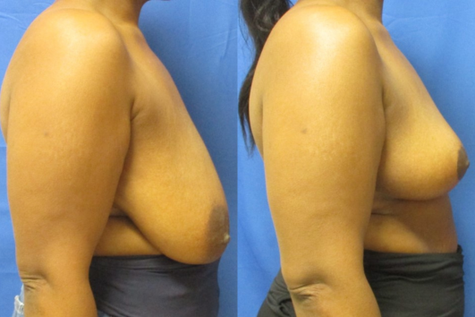 breast reduction before & after