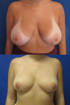 breast reduction before & after