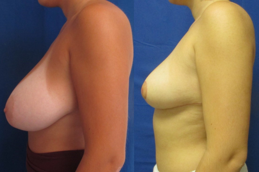 breast reduction before & after