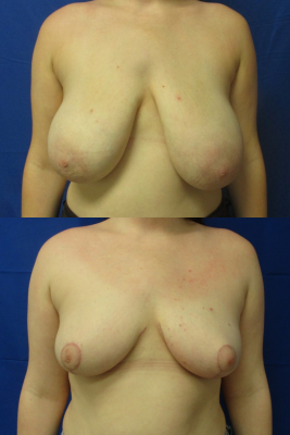 breast reduction before & after