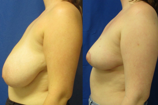 breast reduction before & after