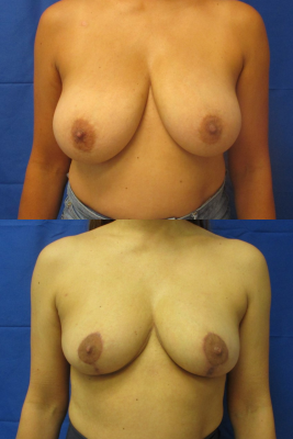 breast reduction before & after