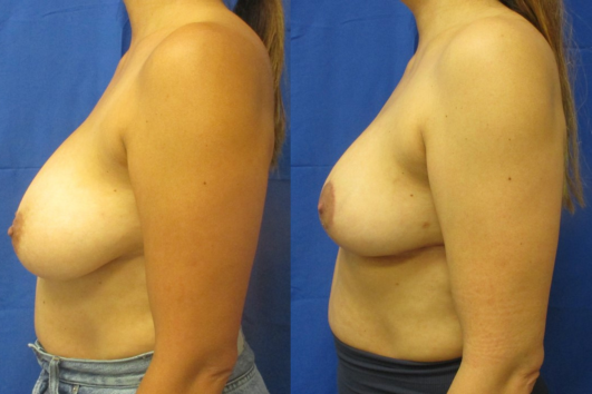 breast reduction before & after