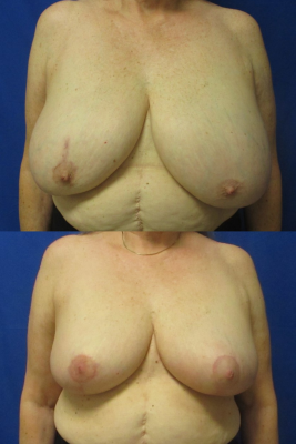 breast reduction before & after