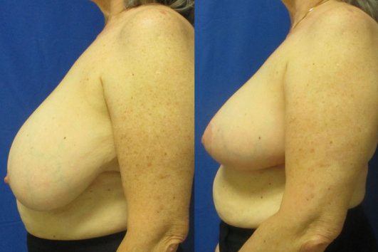 breast reduction before & after