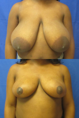 breast reduction before & after