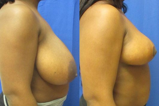 breast reduction before & after