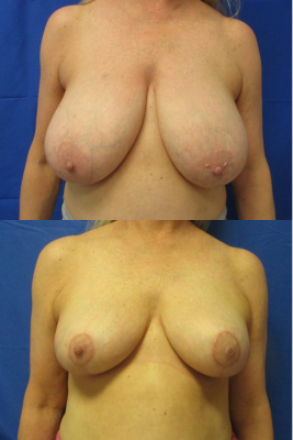 breast reduction before & after