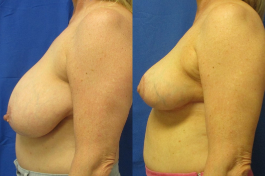 breast reduction before & after