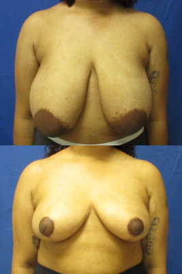breast reduction before & after