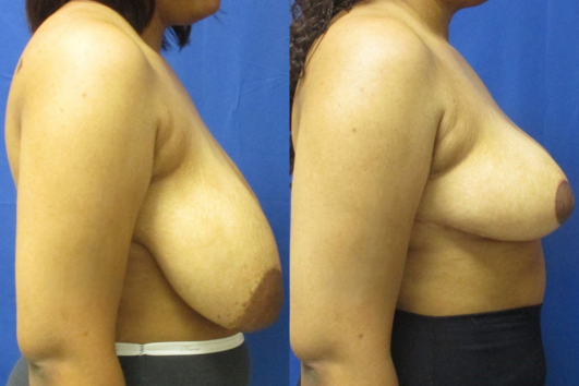 breast reduction before & after