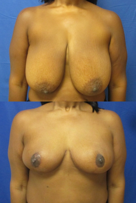 breast reduction before & after