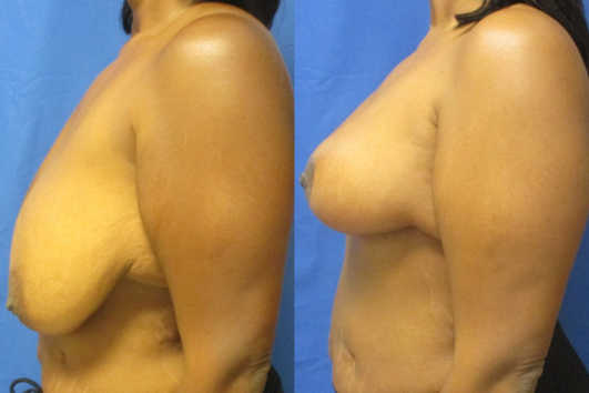 breast reduction before & after