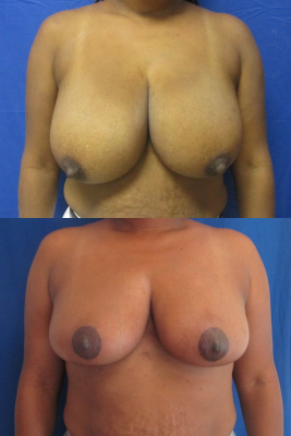 breast reduction before & after