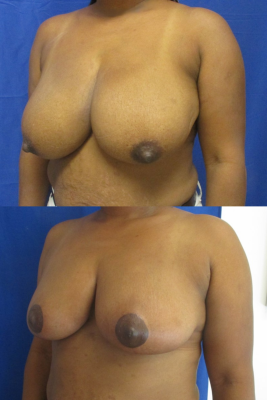 breast reduction before & after