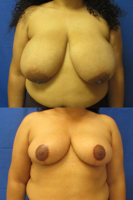 breast reduction before & after