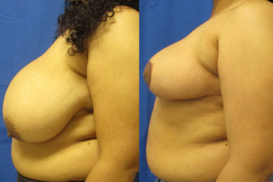 breast reduction before & after