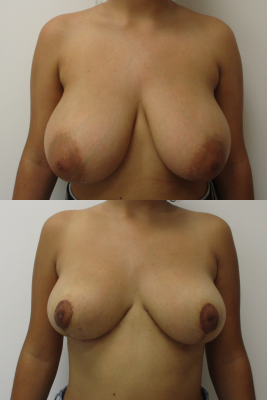 breast reduction before & after