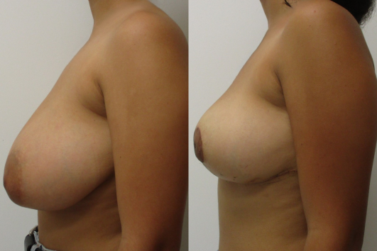 breast reduction before & after