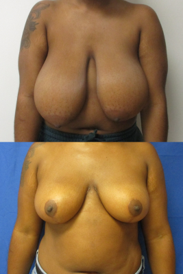 breast reduction before & after